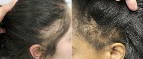 Uneven Hairlines Why It Happens And How To Fix It