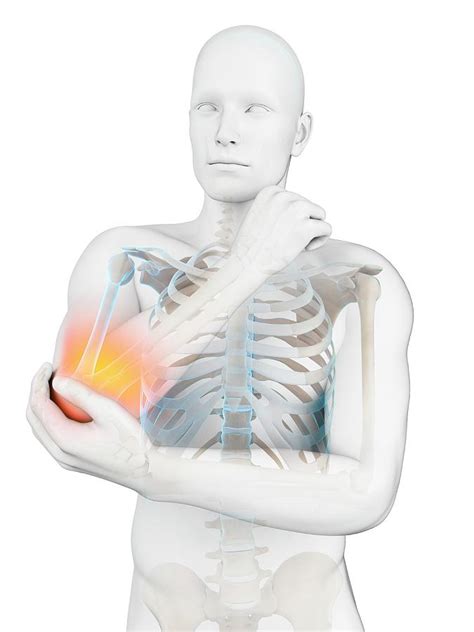 Human Elbow Pain Photograph By Sebastian Kaulitzki Science Photo