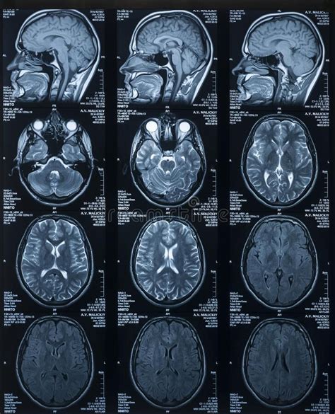 Mri Scan Of The Brain Medicine And Health §ð Vertical Photo
