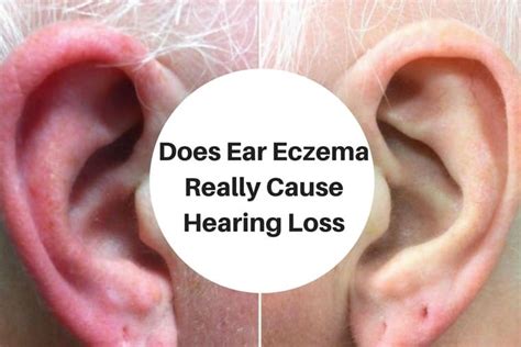 Scaly Flaky Skin Behind Ears Toxoplasmosis
