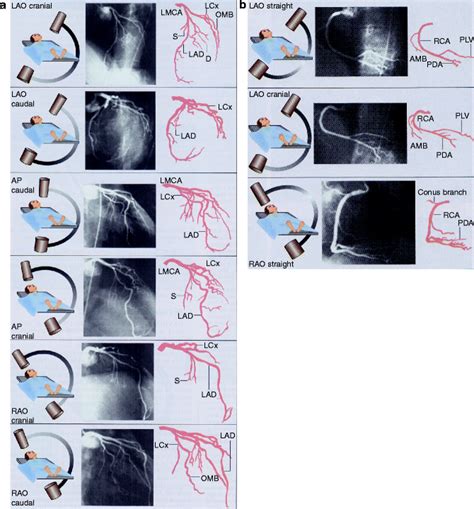 Invasive Coronary Angiography Springerlink
