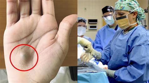 Trend A Man Found This Strange Lump On His Palm Then A Scan Revealed