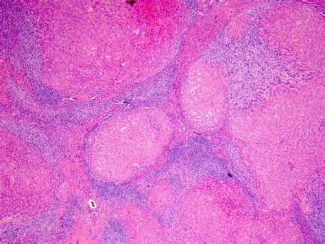 Pathology Outlines Focal Nodular Hyperplasia