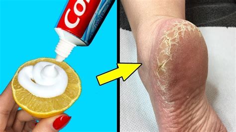 How To Remove Cracked Heels And Get Beautiful Feet Magical Cracked