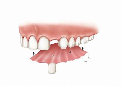 Partial Denture Teeth Dental Dentures Implant Missing