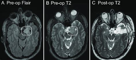 A And B Axial Mri Of The Brain Showing The T2 Fluid Attenuated