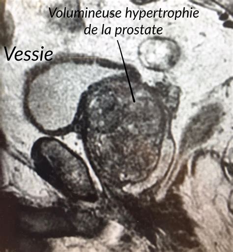 HoLEP Traiter lHypertrophie bénigne de prostate Urologie Grand Est