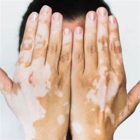 White Spots And Patches On My Skin Vitiligo Treatment Usa