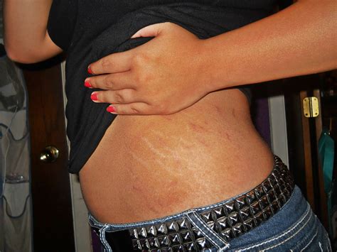 real women have stretch marks well i m not so comfortable… flickr