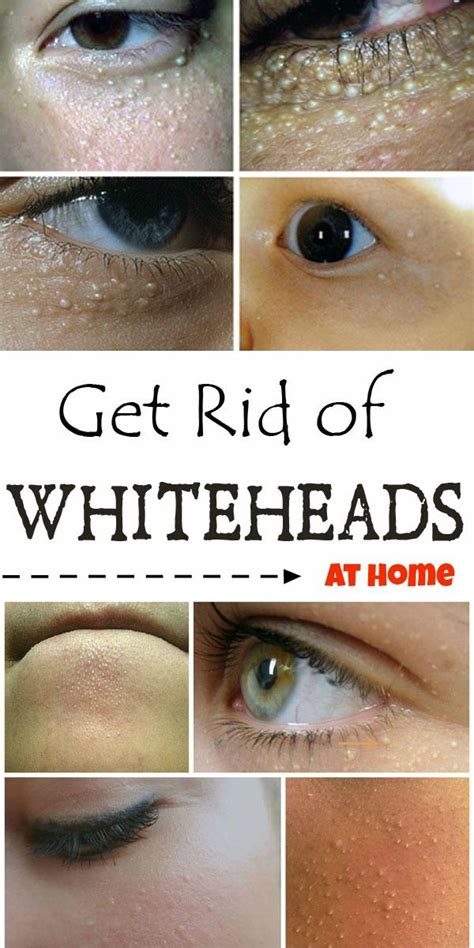 How To Get Rid Of Whiteheads On Face Beauty Tips Diary Chin
