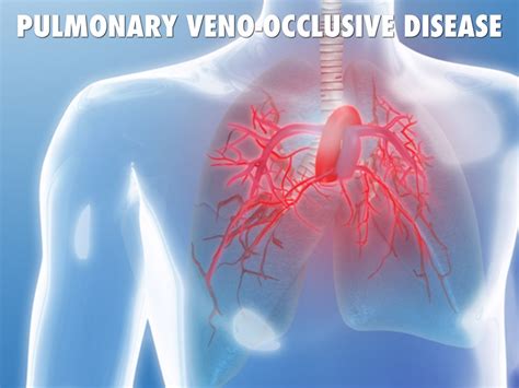 Pulmonary Veno Occlusive Disease By Hovav Azulay