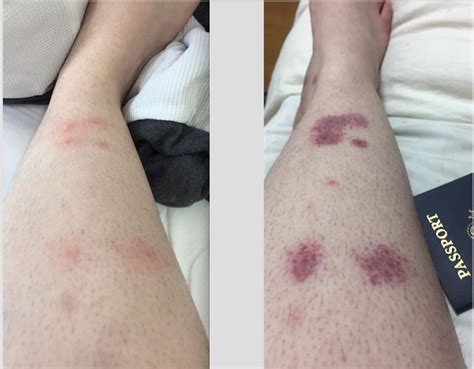 Leg Rash Bug Bites Ask A Doctor Free Doctors Online Your Medical