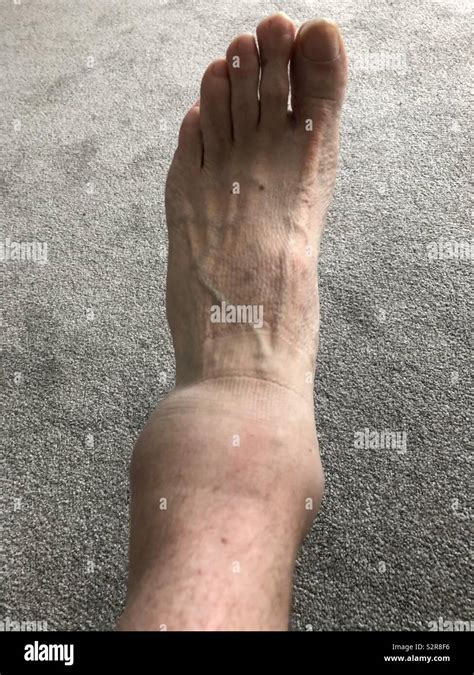 Badly Sprained And Swollen Ankle Stock Photo Alamy