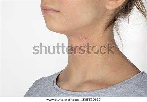 Allergic Itchy Skin On Girl Neck Stock Photo Edit Now 1585530937