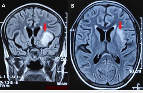 Coronal A And Axial B Sections Of Flair Sequence Of Mri Brain