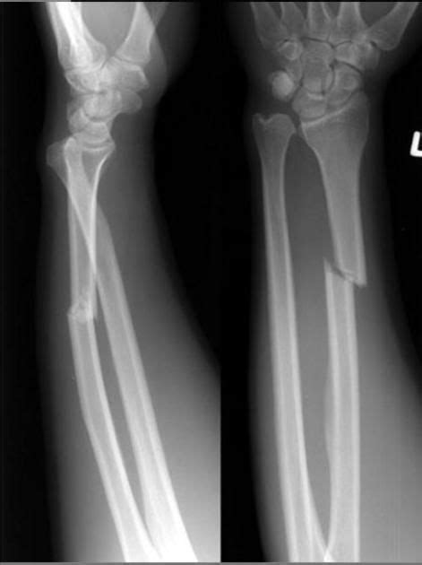 Galeazzi Fracture Dislocation Radiology Reference Article