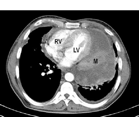 Contrast Enhanced Axial Ct Image Shows A Large Download Scientific