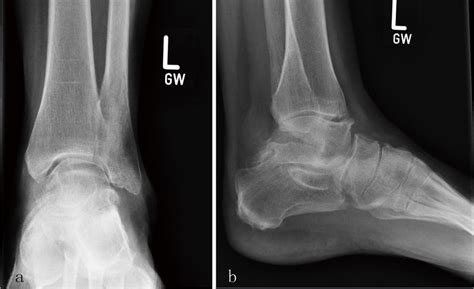 Ap And Lateral Radiograph Of The Left Ankle Showing Ball And Socket