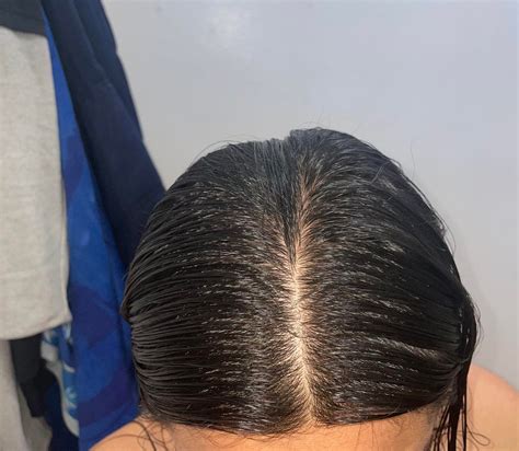 2 Months Into My Shed With Minoxidil And 6 Months Of Aggressive