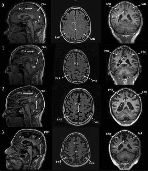 Visual Assessment Of Posterior Atrophy Development Of A Mri Rating