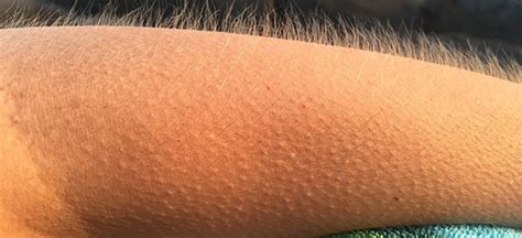 The Common Reasons Behind Goosebumps On Skin