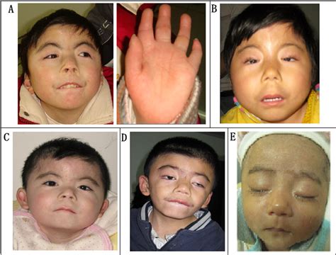 Figure 1 From Two Novel Nipbl Gene Mutations In Chinese Patients With Cornelia De Lange Syndrome
