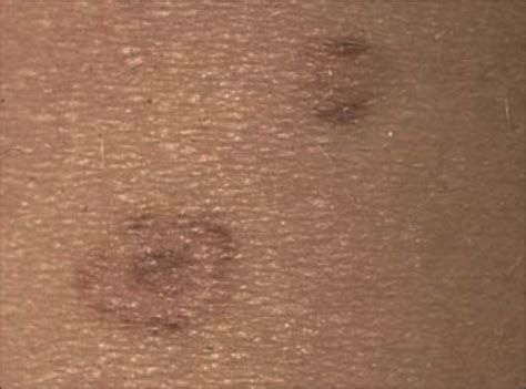 The Significance Of Targetoid Nevus Dermatology Jama Dermatology