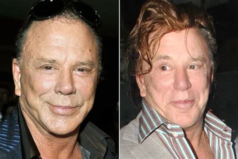 Mickey Rourke Facelift Plastic Surgery Before And After Celebie
