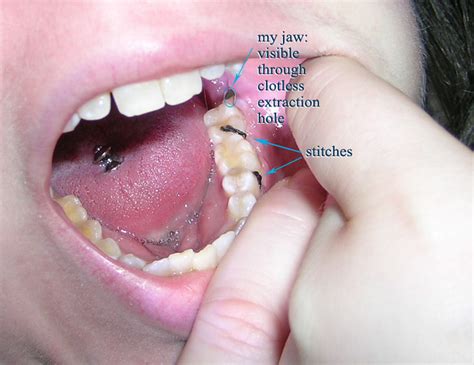 Blood clot wisdom teeth real pictures. labeled dry socket close-up | Flickr - Photo Sharing!