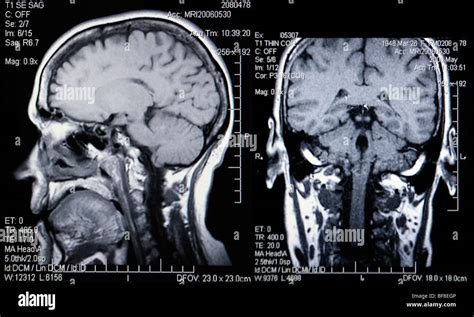 Dual View Of Real Mri Scans Of The Head And Brain Stock Photo Alamy