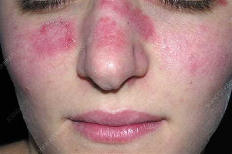 Lupus Lesions On Face