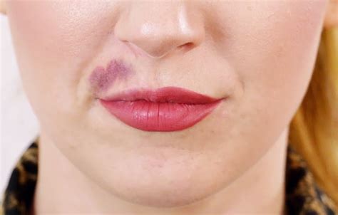How Can You Limit Bruising With Botox And Cosmetic Fillers — Boulder