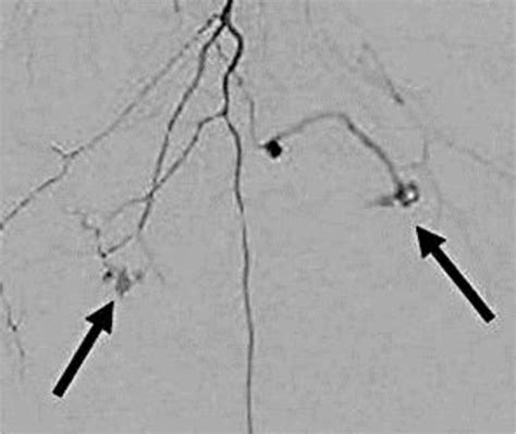 Right Lateral Circumflex Femoral Artery Angiogram Showing An Aneurysm