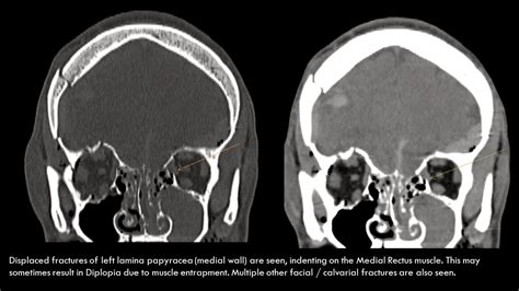 Ultimate Radiology : Orbital Blow-out Fractures