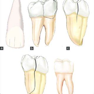 American Association of Endodontists classification of a ...