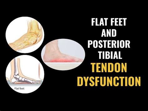 Flat Feet And Posterior Tibial Tendon Dysfunction Youtube