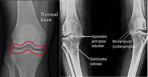 Knee Replacement Ligaments And Joints Suregery