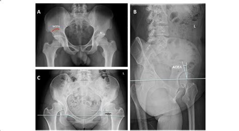 Measurements Of Radiographic Parameters In Anteroposterior And 65° Download Scientific Diagram