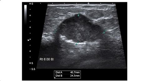 B Mode Us Shows Oval Shaped Hypoechoic Solid Mass With Lobulated