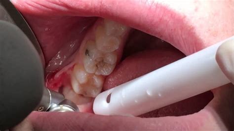 Signs You Need To Have Your Wisdom Tooth Taken Out Collected By Tas Ka
