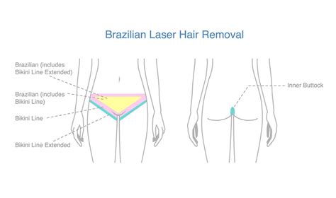 Laser Brazilian