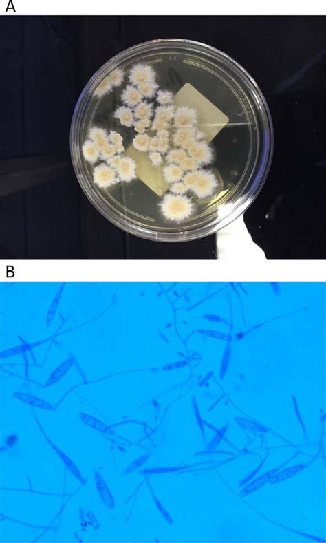 Kerion Celsi Caused By Microsporum Gypseum The Journal Of Pediatrics