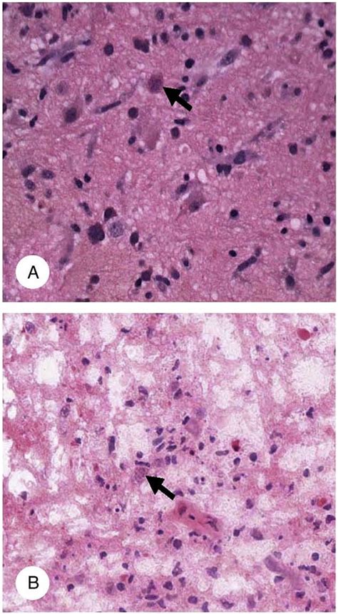 Toxoplasmosis In A Brain Biopsy From An Hiv Positive Patient Panel A