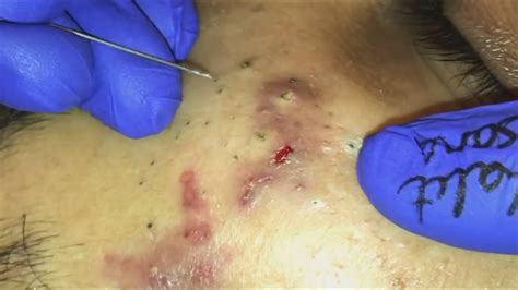 The growth actually got so bad the unfortunate little soul said her life has been turned upside down and has even been 'that was the biggest pilar cyst i've ever seen,' she continued, unnervingly cool, calm and. Full Blackhead Popping Video - HOT 2019 - Part47 - Pimple ...