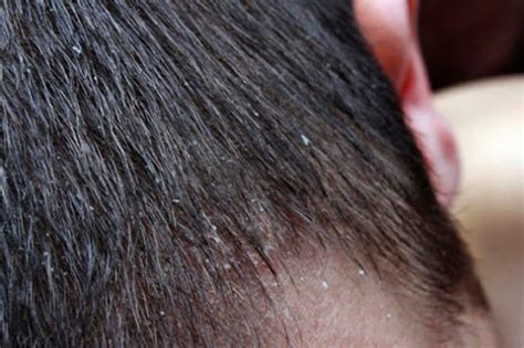Qué es la Dermatitis Seborreica en el cuero cabelludo