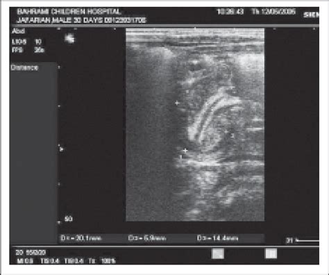 Longitudinal Sonogram Of The Pyloric Channel In An Infant With Pyloric