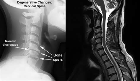 A bone spur may be caused by degenerative arthritis or tendonitis. Cervical Spondylosis | Neck Pain | Tests and Treatment