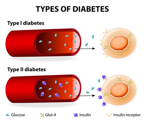 Types Of Diabetes Type 1 Type 2 Gestational Diabetes