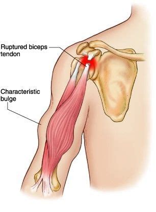 Biceps Tendon Rupture Muscle Belly Bicep Muscle Physical Wellness