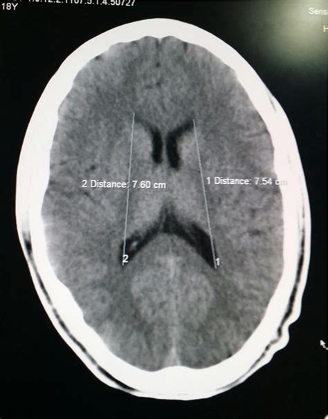 Figure 1 From Measurement Of Normal Brain Lateral Ventricles Byusing Ct